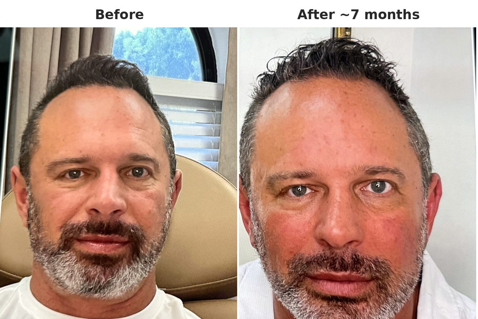 Before and after about 7 months of using Cell Revival X cream: smoother-looking skin texture and more even-looking tone